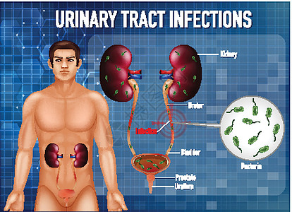 尿路感染信息海报微生物学科学绘画艺术病理教育夹子生理解剖学膀胱图片