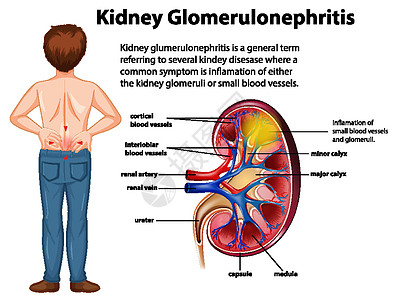 肾小球硬化的医学信息图男性科学药品症状绘画微生物学男人病理肾脏图表图片