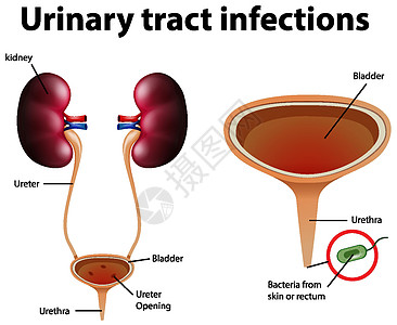 尿路感染的资料图症状学习图表解剖学生理细菌生物学器官输尿管身体图片