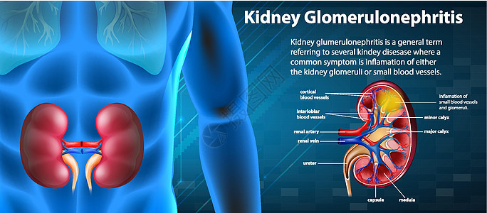 肾小球硬化的医学信息图科学教育症状生理插图疼痛图表艺术夹子微生物学图片