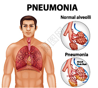 健康肺泡与肺炎的比较空气微生物学男性疾病卡通片信息气体器官图表感染图片