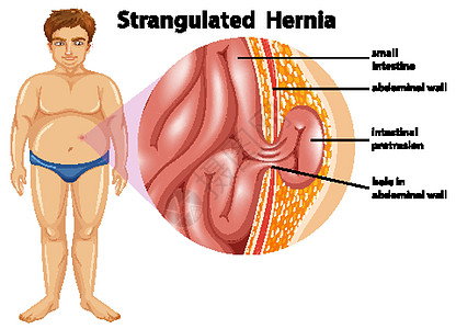 男人绞窄性疝气图片