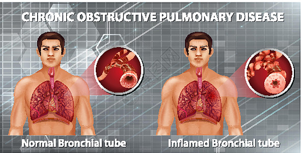 慢性阻塞性肺病微生物学病理信息绘画插图x光生理管子器官疾病图片