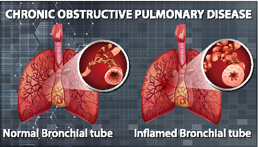 慢性阻塞性肺病药品管子微生物学学习插图疾病教育解剖学生物学病理图片