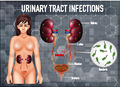 尿路感染的资料图生物学药品学习卡通片尿道插图感染女士解剖学海报图片