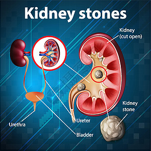 肾结石资料图艺术生物学医疗药品插图卡通片科学图表解剖学生理图片