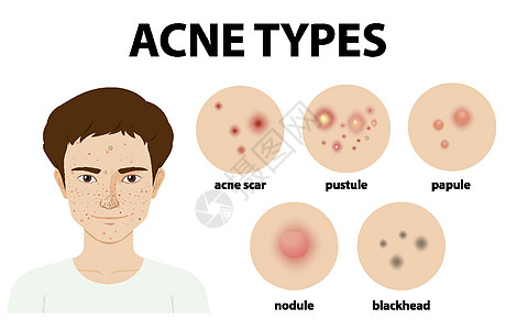皮肤上的粉刺或粉刺类型插图清洁白头绘画护理结节真皮卡通片眼睛疾病图片
