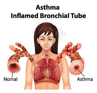 哮喘发炎的支气管管女性解剖学学习女士生物学病理科学信息药品卡通片图片