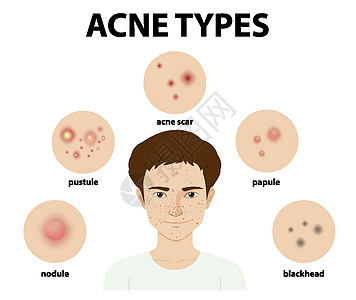 皮肤上的粉刺或粉刺类型指示牌绘画结节卡通片白头插图瘢痕眼睛空白真皮图片