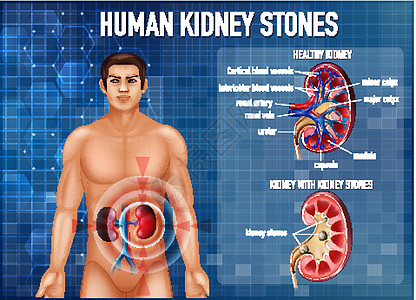 肾结石资料图生理膀胱药品图表男性病理解剖学学习医疗意义图片