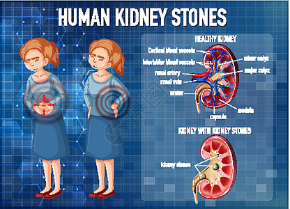 肾结石资料图石头信息微生物学胶囊插图症状疼痛药品生物学科学图片