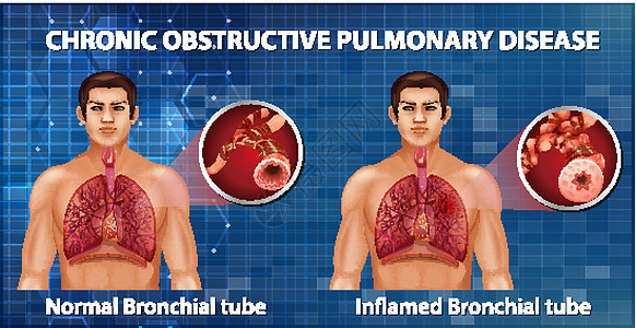 慢性阻塞性肺病病理x光支气管器官管子生理信息解剖学疾病药品图片