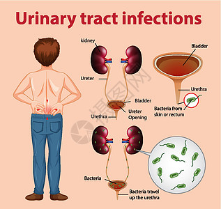 尿路感染的资料图细菌疾病输尿管解剖学病理药品海报感染卡通片器官图片