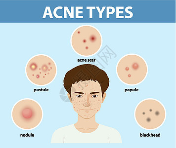 皮肤上的粉刺或粉刺类型毛孔疾病真皮卡通片眼睛瘢痕结节清洁黑头白头图片