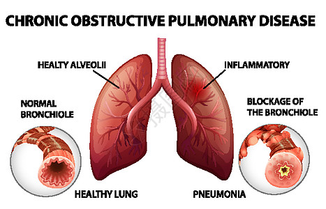 慢性阻塞性肺病x光绘画学习病理科学微生物学生理生物学药品图表图片