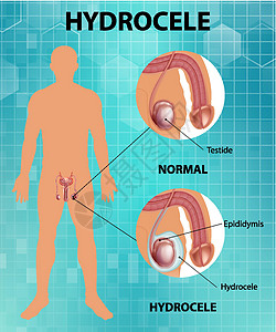 显示男性正常睾丸和鞘膜积液之间差异的医学海报卡通片状况药品教育图表学习信息男人疼痛疾病图片