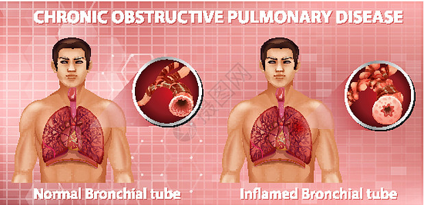 慢性阻塞性肺病科学病理药品管子学习器官生物学疾病信息生理图片