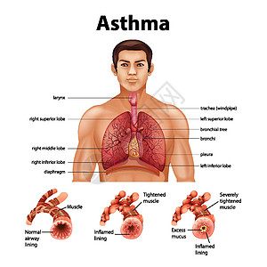 健康肺与哮喘肺的比较微生物学解剖学绘画学习身体信息生理男人卡通片男性图片