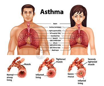 健康肺与哮喘肺的比较疾病学习器官身体哮喘病女士x光女性生理海报图片