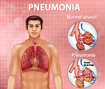 健康肺泡与肺炎的比较科学空气x光学习病理绘画教育气管疾病信息图片
