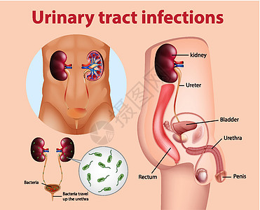 尿路感染的资料图身体细菌图表尿道学习绘画男性教育微生物学刀片图片