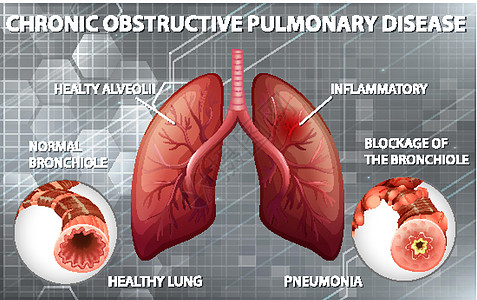 慢性阻塞性肺病教育图表x光支气管插图微生物学生物学疾病病理学习图片