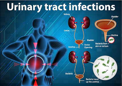 尿路感染的资料图身体器官药品科学输尿管感染生物学教育海报绘画图片