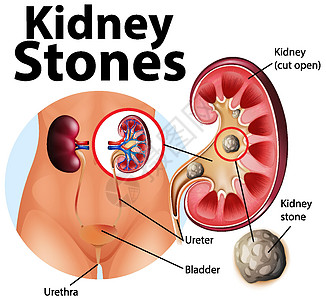 肾结石资料图图表科学意义尿道绘画身体药品插图教育剪贴图片