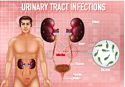 尿路感染的资料图绘画海报输尿管教育图表学习尿道刀片科学药品图片