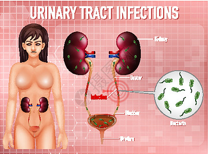 尿路感染的资料图生理微生物学女性刀片生物学海报科学图表卡通片疾病图片