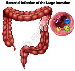 大肠细菌感染图片