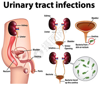 尿路感染的资料图微生物学图表海报男性尿道卡通片细菌插图科学输尿管图片