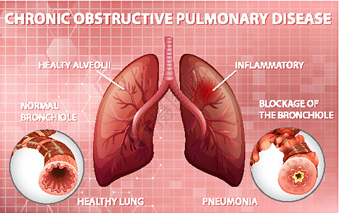 慢性阻塞性肺病生理教育解剖学科学微生物学生物学管子药品图表疾病图片