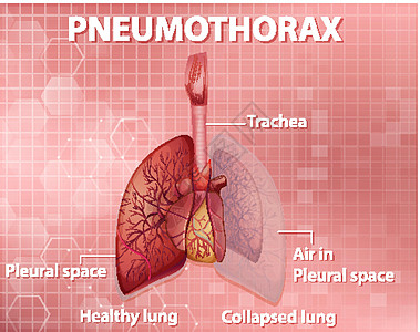 气胸的资料图卡通片生物学剪贴x光学习空气图表生理肺泡教育图片