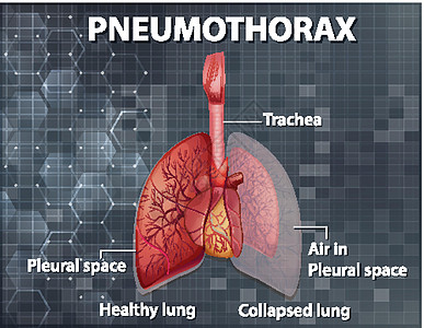 气胸的资料图教育科学绘画气体感染空气肺泡微生物学生物学图表图片