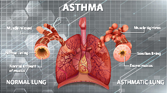 健康肺与哮喘肺的比较身体x光图表病理学习生理微生物学哮喘病支气管药品图片