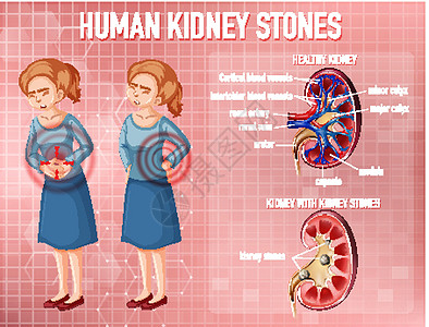 健康肾与结石肾对比身体医疗病理信息科学插图肾脏女性微生物学图表图片