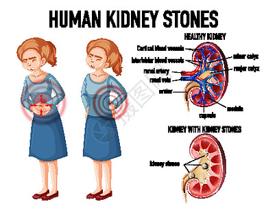 健康肾与结石肾对比意义器官教育女性绘画生理微生物学信息图表女士图片