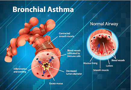 哮喘发炎的支气管管海报管子器官教育图表支气管病理学习哮喘病身体图片