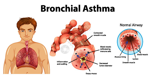 哮喘发炎的支气管管海报x光生理器官剪贴生物学绘画信息微生物学学习图片