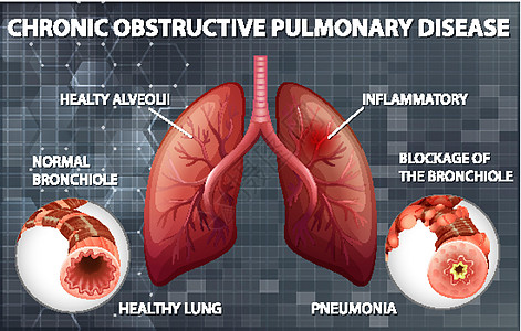 慢性阻塞性肺病解剖学绘画药品信息病理管子生物学插图教育器官图片