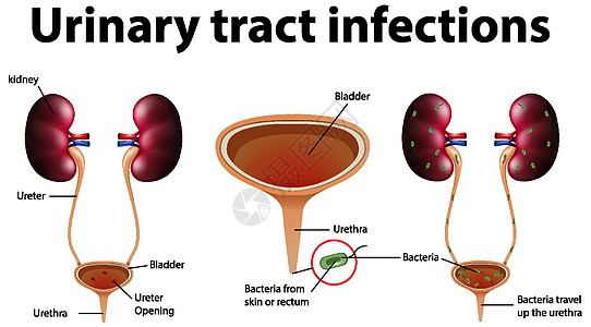 尿路感染的资料图海报药品尿道身体病理感染疾病教育刀片图表背景图片