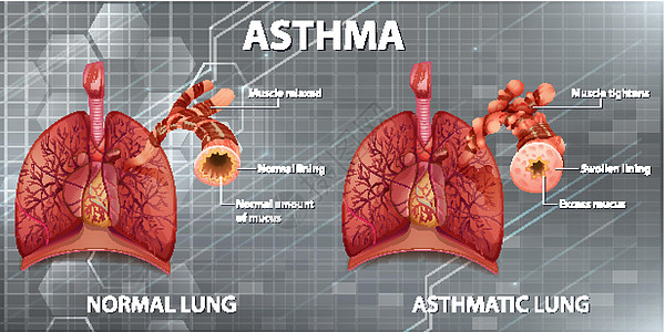 人体解剖学哮喘图插图疾病海报绘画哮喘病生物学生理图表科学药品图片