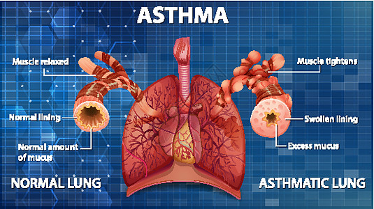 人体解剖学哮喘图解剖学插图海报微生物学教育病理图表信息绘画哮喘病图片
