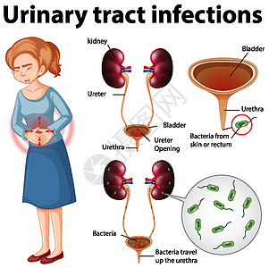 尿路感染的资料图感染微生物学科学生理生物学卡通片教育海报绘画药品图片