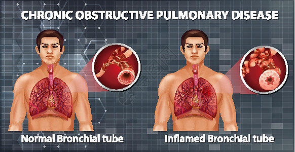 慢性阻塞性肺病科学支气管生理图表器官x光绘画病理解剖学信息图片