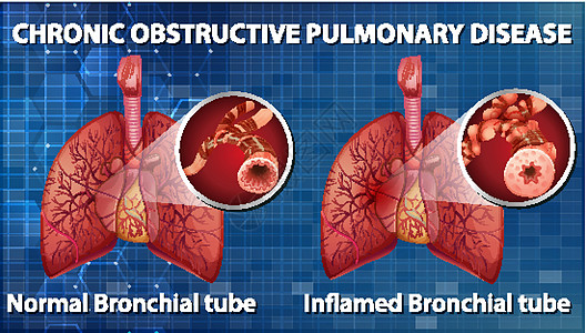 慢性阻塞性肺病信息生物学解剖学教育科学疾病微生物学支气管图表器官图片