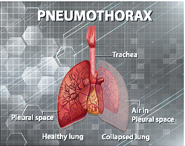 气胸的资料图图表生物学微生物学科学x光器官生理学习剪贴绘画图片