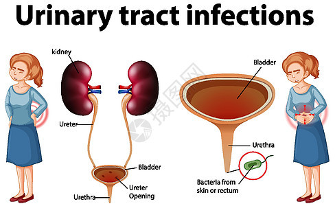 尿路感染的资料图疾病生物学科学生理教育解剖学身体绘画微生物学海报图片