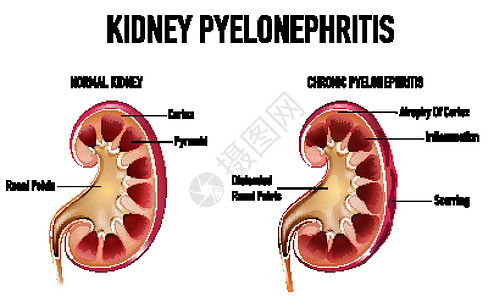 肾盂肾炎的资料图科学肾盂感染药品疤痕金字塔皮层器官生理信息图片